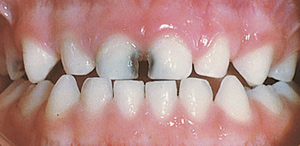 toddlers front teeth decaying