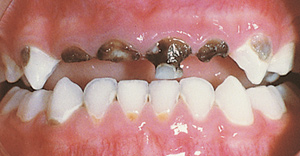 toddlers front teeth decaying